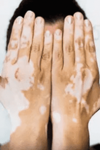 og_vitiligo